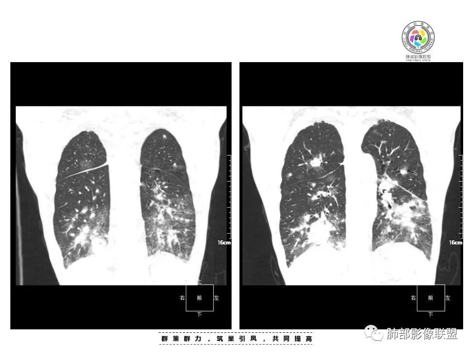 影像PPT - 【病例】HIV卡波西肉瘤1例肺部影像表现-12