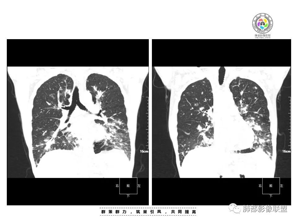 影像PPT - 【病例】HIV卡波西肉瘤1例肺部影像表现-13