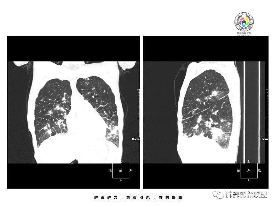 影像PPT - 【病例】HIV卡波西肉瘤1例肺部影像表现-14