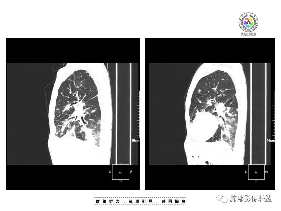 影像PPT - 【病例】HIV卡波西肉瘤1例肺部影像表现-15