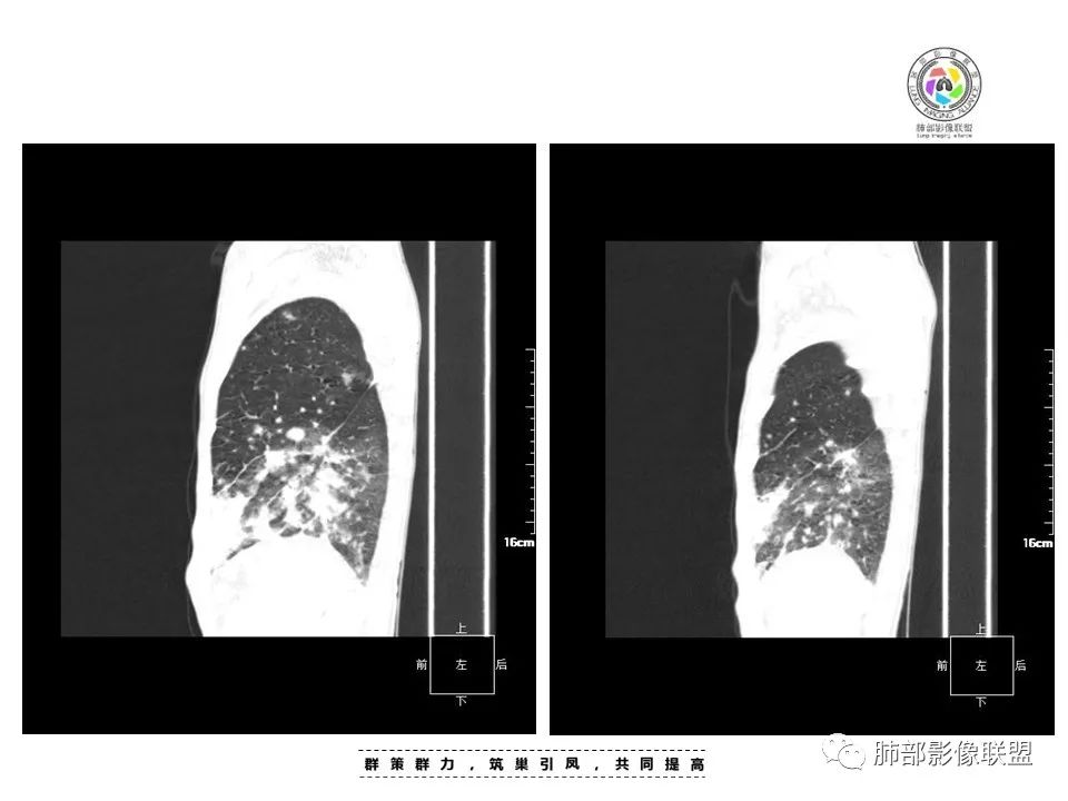 影像PPT - 【病例】HIV卡波西肉瘤1例肺部影像表现-16