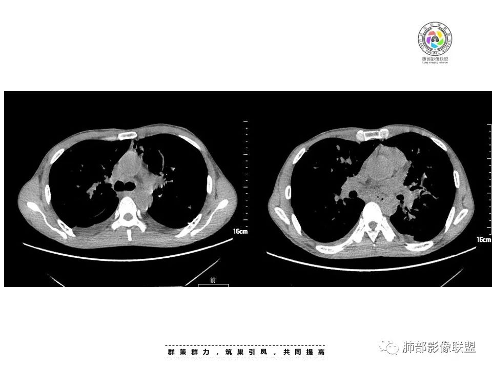 影像PPT - 【病例】HIV卡波西肉瘤1例肺部影像表现-17