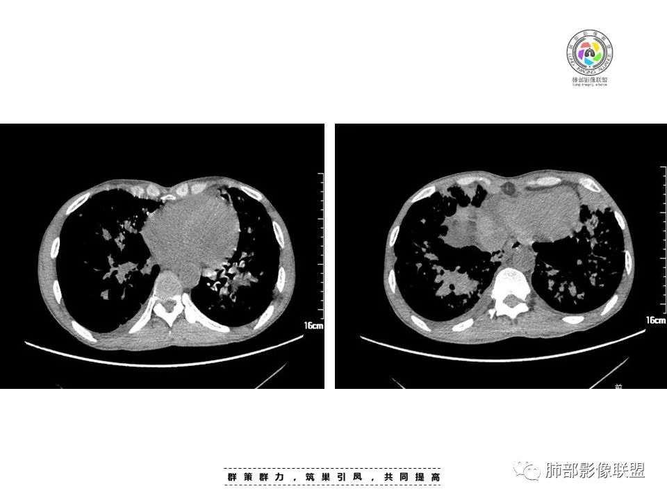 影像PPT - 【病例】HIV卡波西肉瘤1例肺部影像表现-18