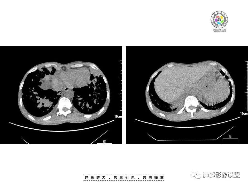 影像PPT - 【病例】HIV卡波西肉瘤1例肺部影像表现-19