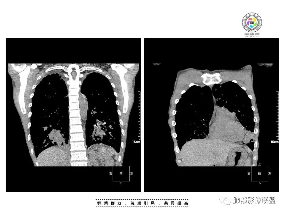 影像PPT - 【病例】HIV卡波西肉瘤1例肺部影像表现-20