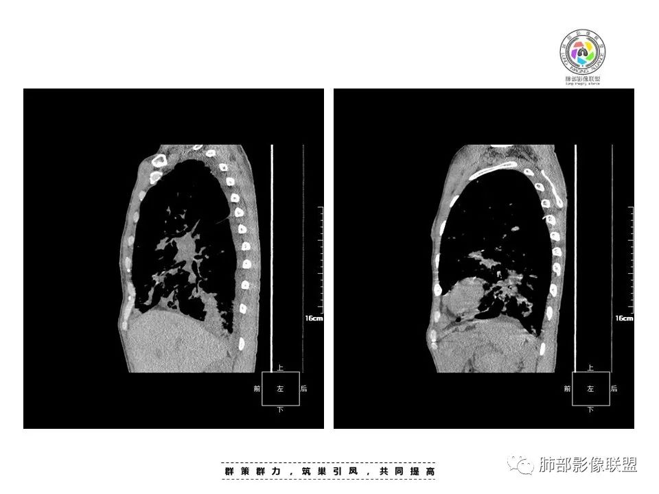影像PPT - 【病例】HIV卡波西肉瘤1例肺部影像表现-21