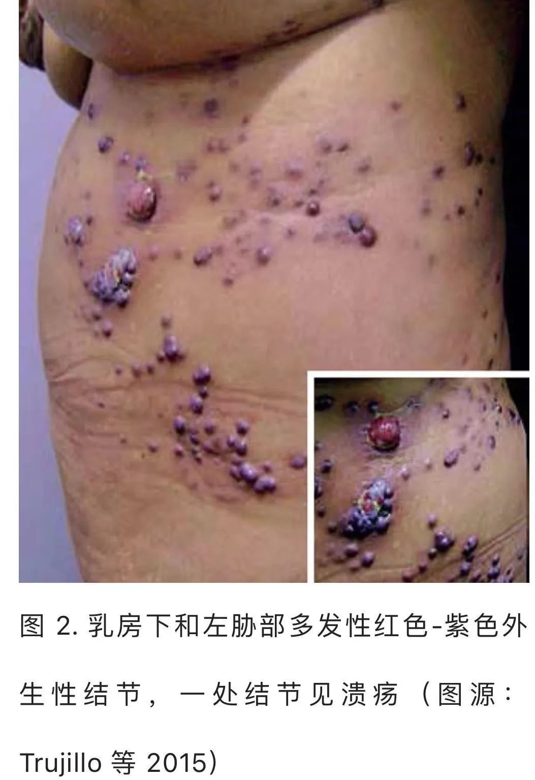 影像PPT - 【病例】HIV卡波西肉瘤1例肺部影像表现-27