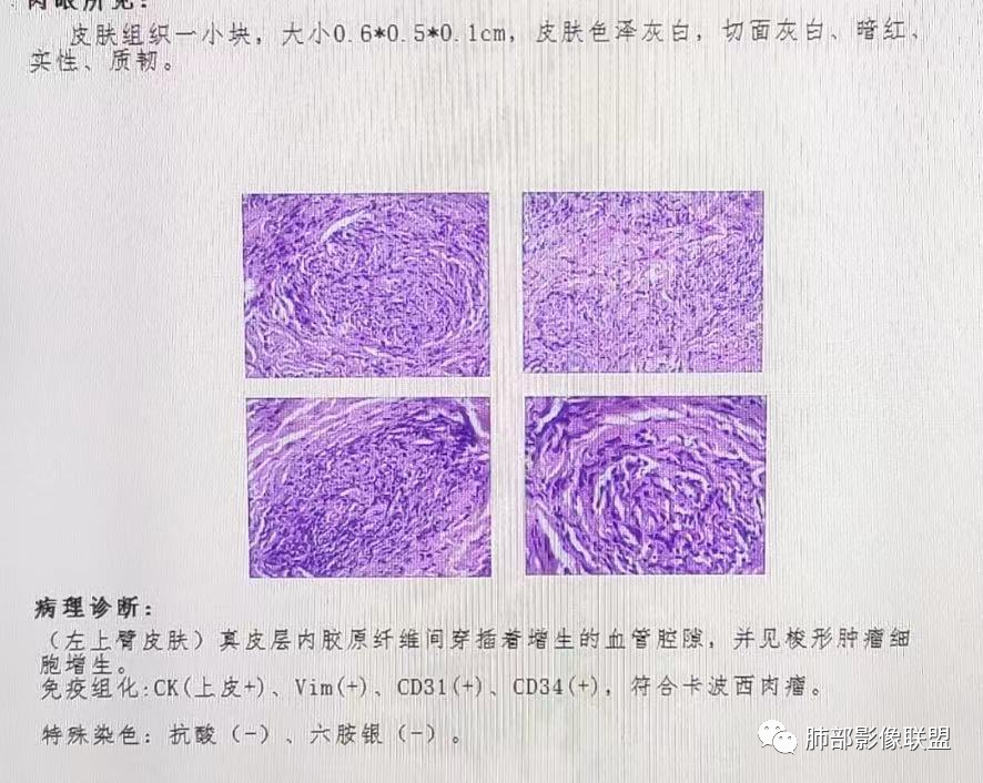 影像PPT - 【病例】HIV卡波西肉瘤1例肺部影像表现-26