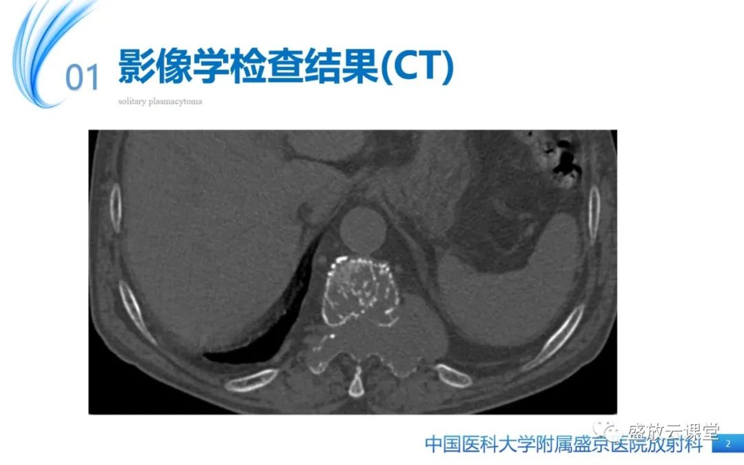 影像PPT - 【PPT】孤立性浆细胞瘤-2