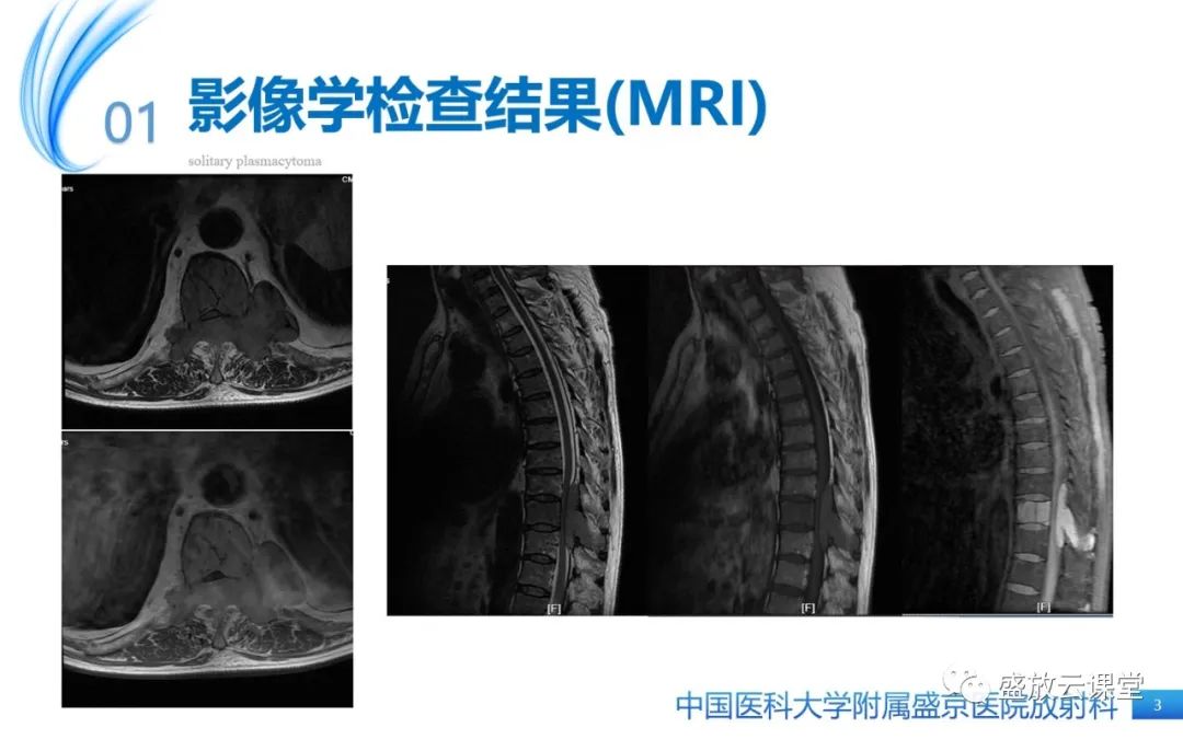 影像PPT - 【PPT】孤立性浆细胞瘤-3