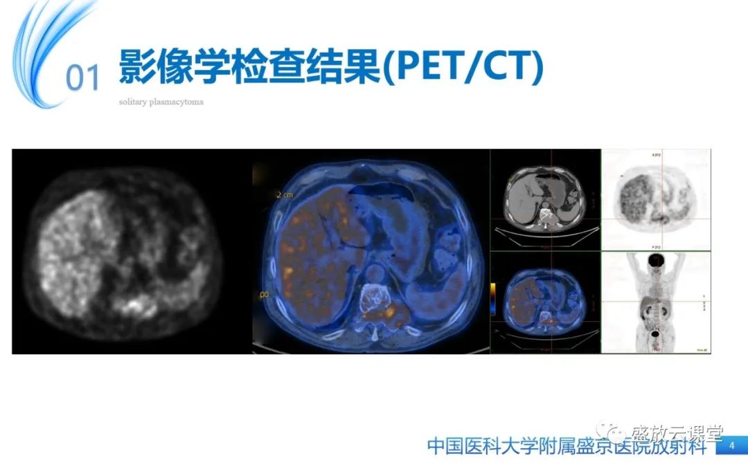 影像PPT - 【PPT】孤立性浆细胞瘤-4