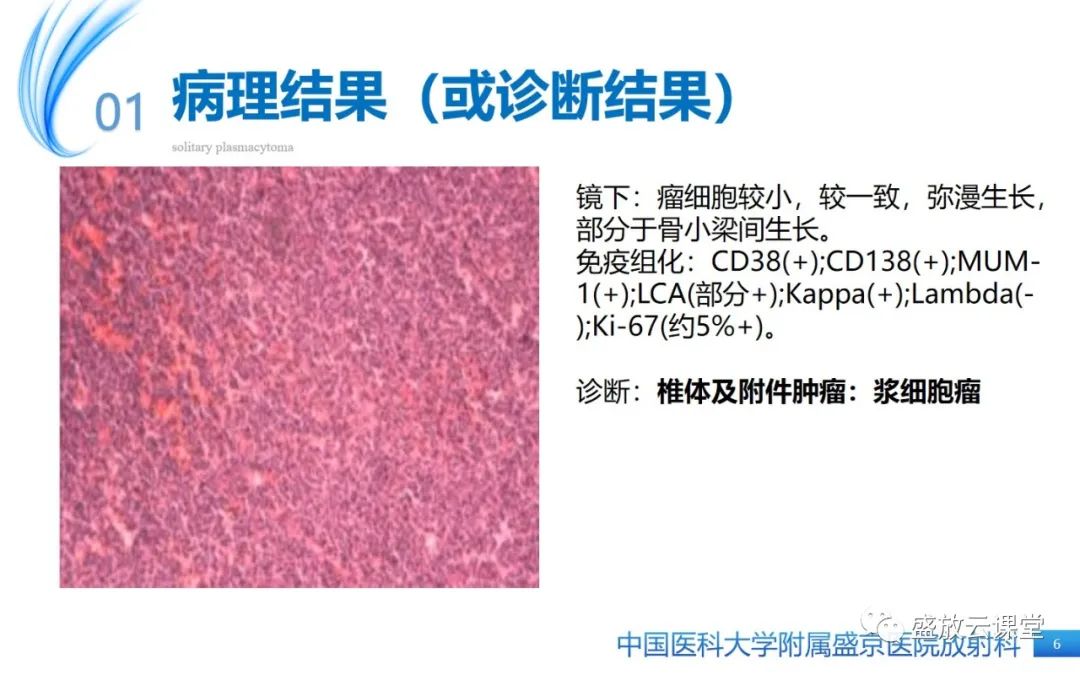 影像PPT - 【PPT】孤立性浆细胞瘤-6