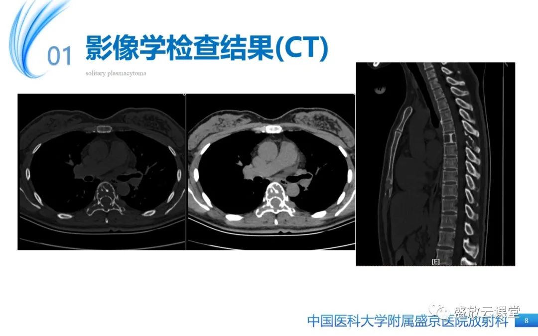 影像PPT - 【PPT】孤立性浆细胞瘤-8