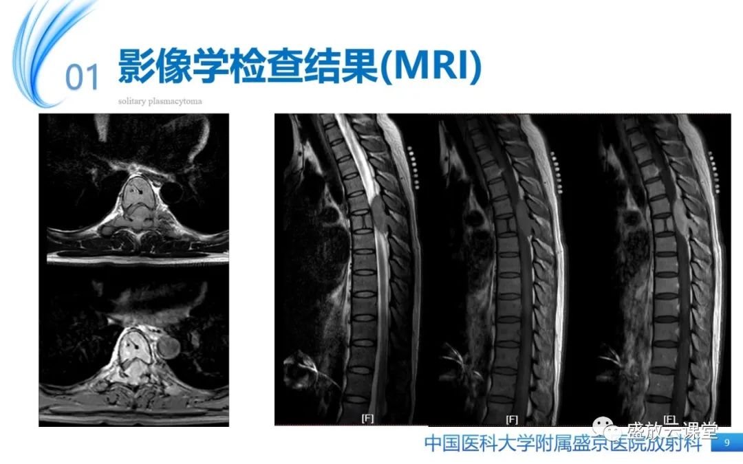 影像PPT - 【PPT】孤立性浆细胞瘤-9