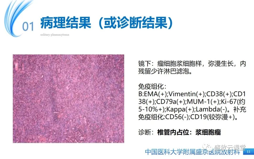 影像PPT - 【PPT】孤立性浆细胞瘤-10