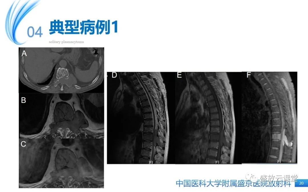 影像PPT - 【PPT】孤立性浆细胞瘤-19