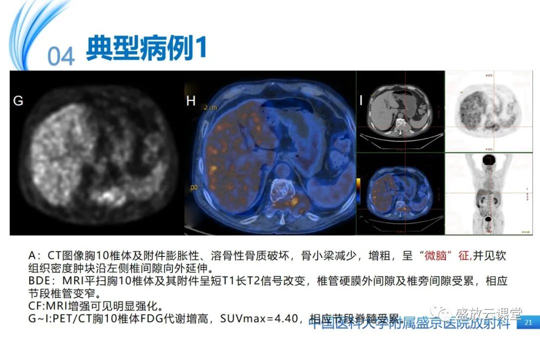 影像PPT - 【PPT】孤立性浆细胞瘤-20