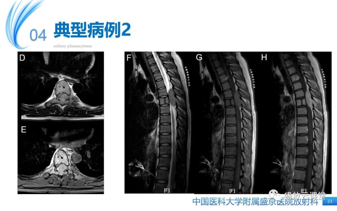 影像PPT - 【PPT】孤立性浆细胞瘤-22