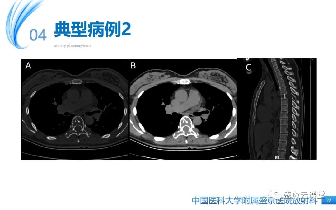 影像PPT - 【PPT】孤立性浆细胞瘤-21