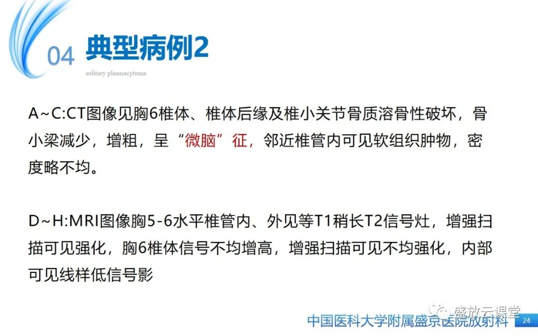 影像PPT - 【PPT】孤立性浆细胞瘤-23