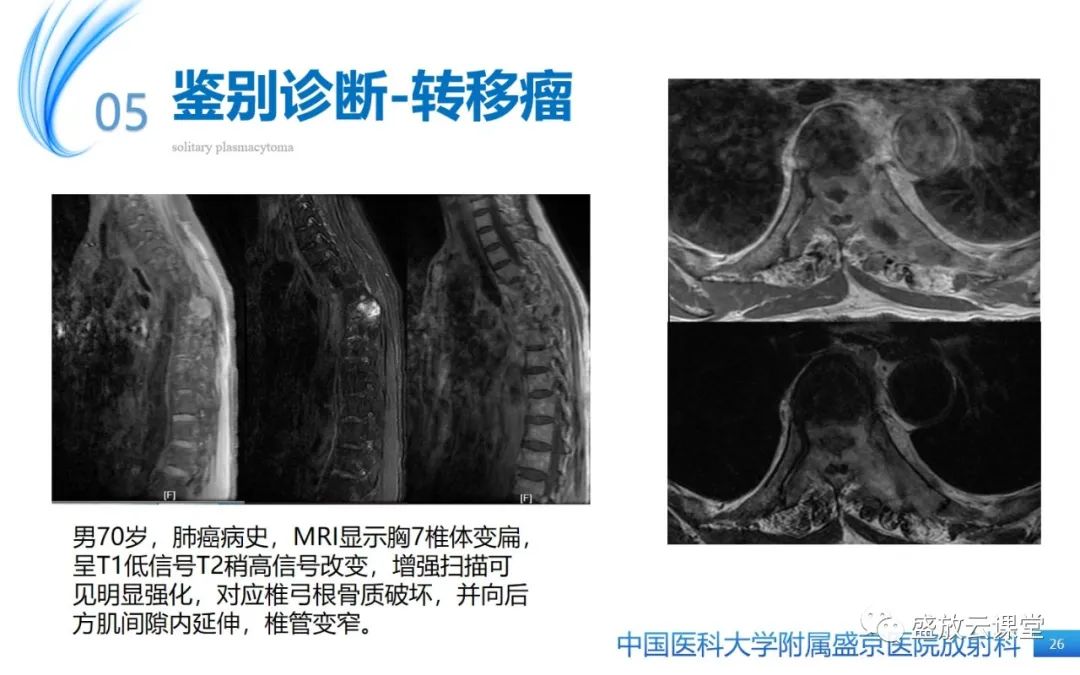 影像PPT - 【PPT】孤立性浆细胞瘤-25