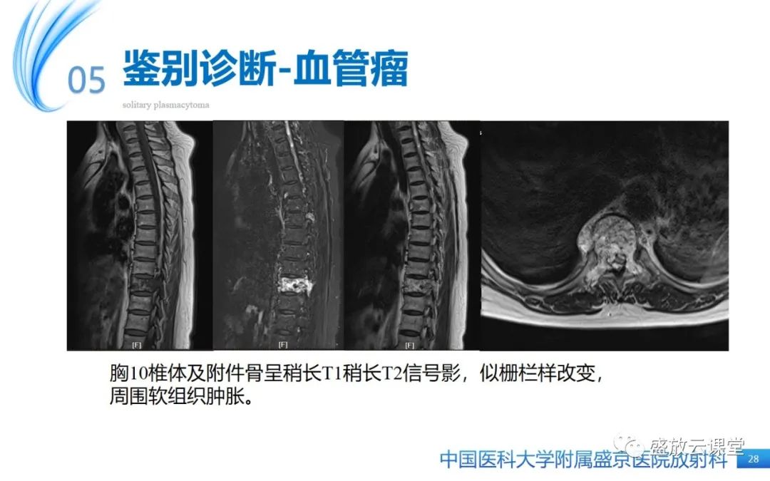 影像PPT - 【PPT】孤立性浆细胞瘤-27