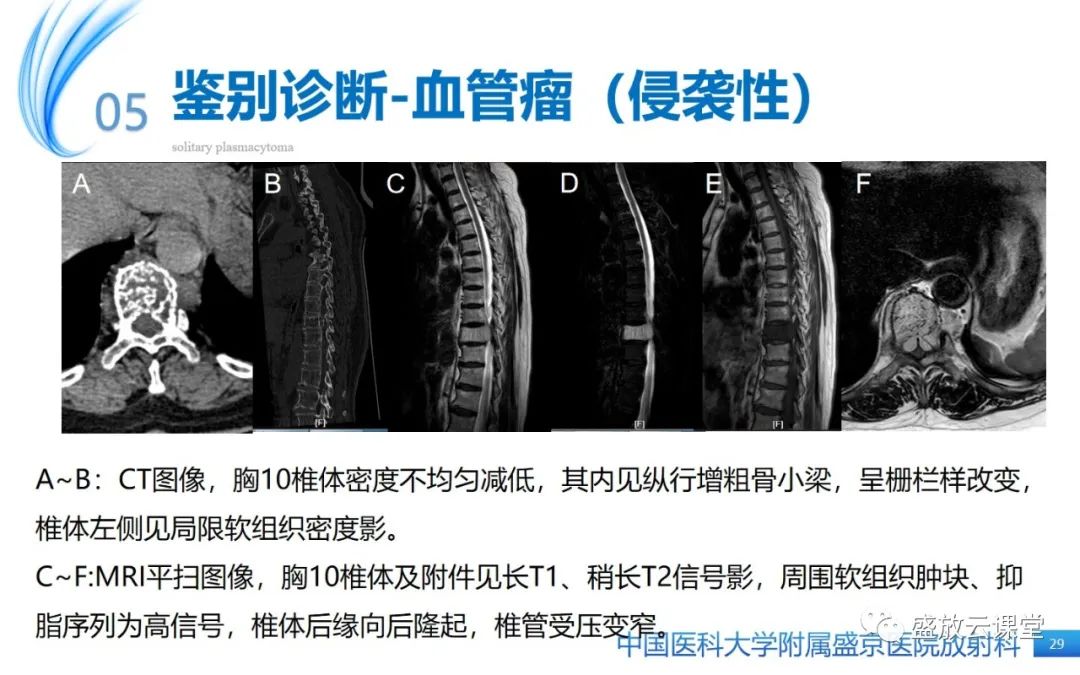 影像PPT - 【PPT】孤立性浆细胞瘤-28