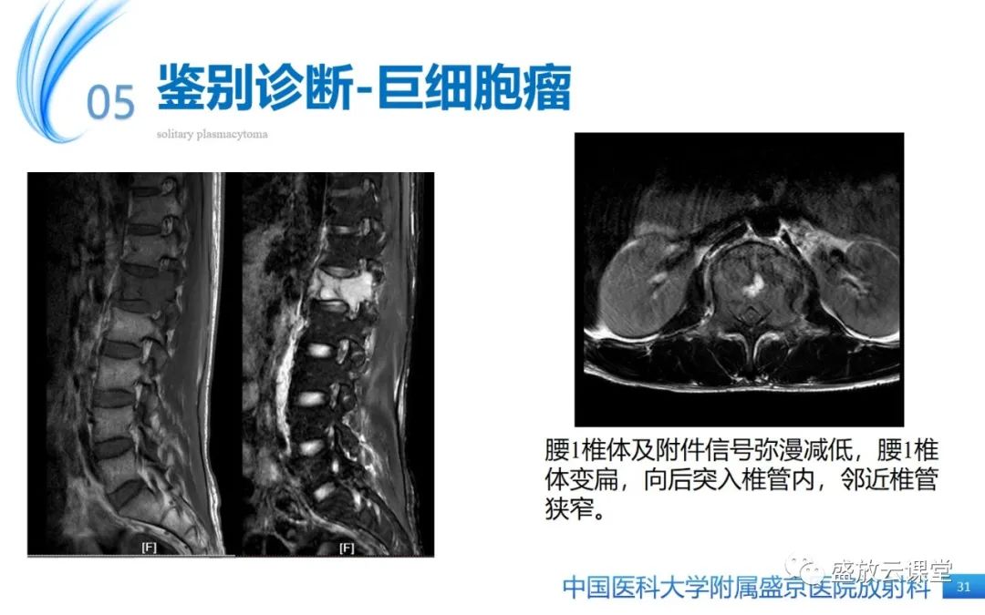 影像PPT - 【PPT】孤立性浆细胞瘤-30
