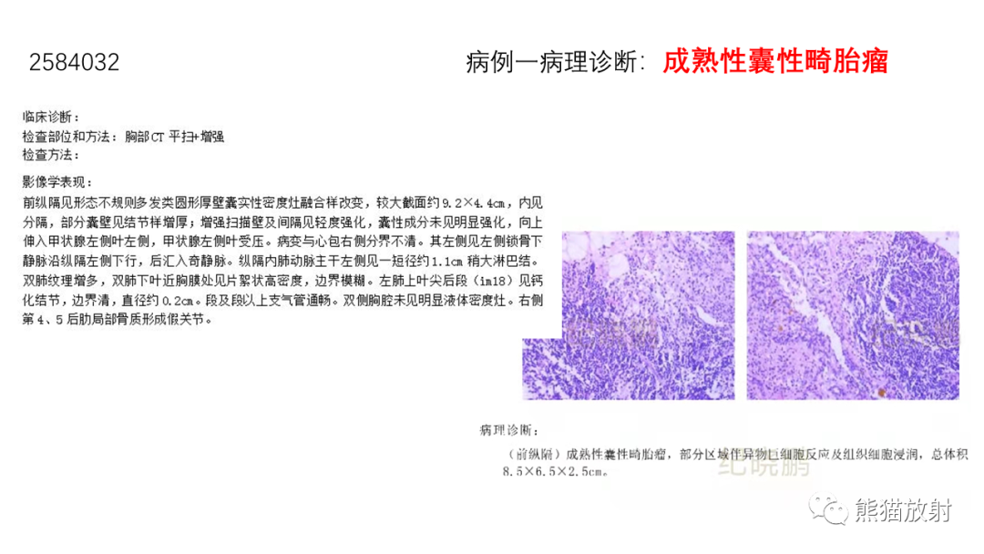 影像PPT - 【病例】前纵隔畸胎瘤2例CT影像-16