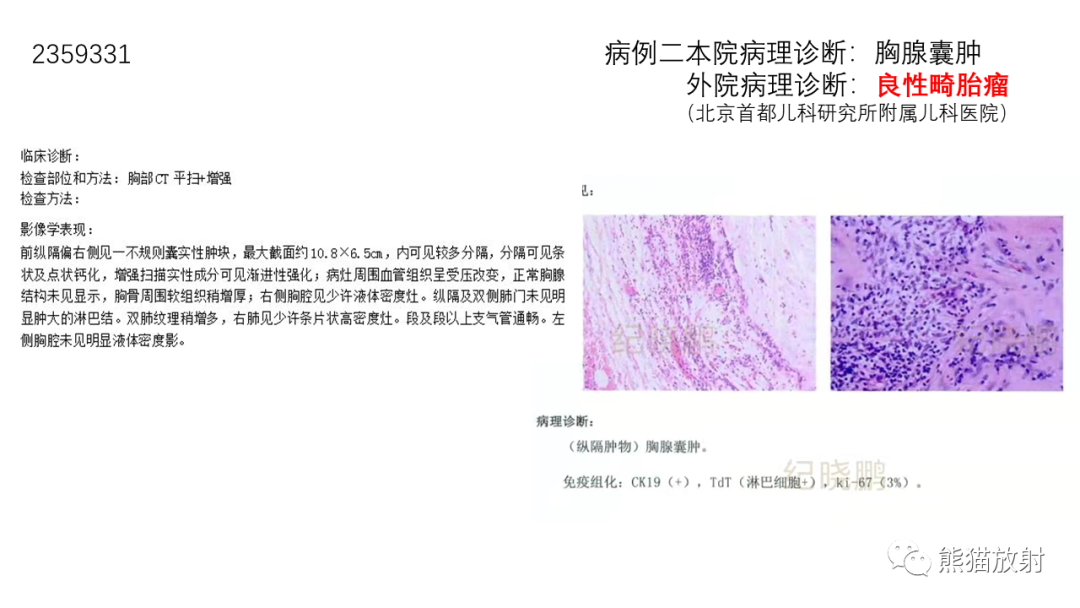 影像PPT - 【病例】前纵隔畸胎瘤2例CT影像-18