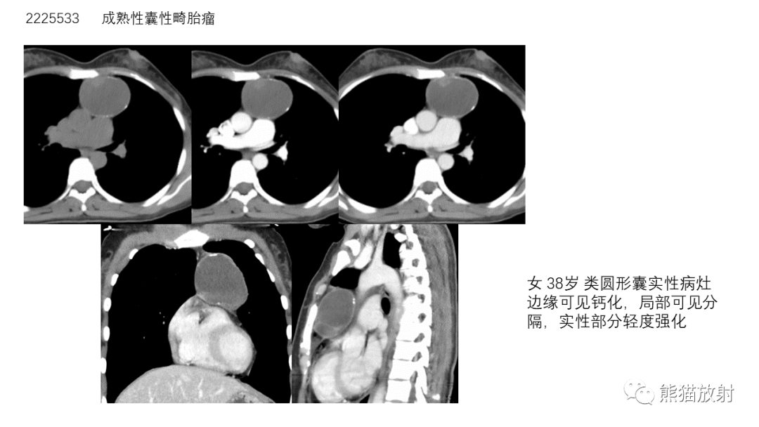 影像PPT - 【病例】前纵隔畸胎瘤2例CT影像-22