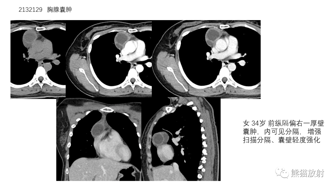 影像PPT - 【病例】前纵隔畸胎瘤2例CT影像-28