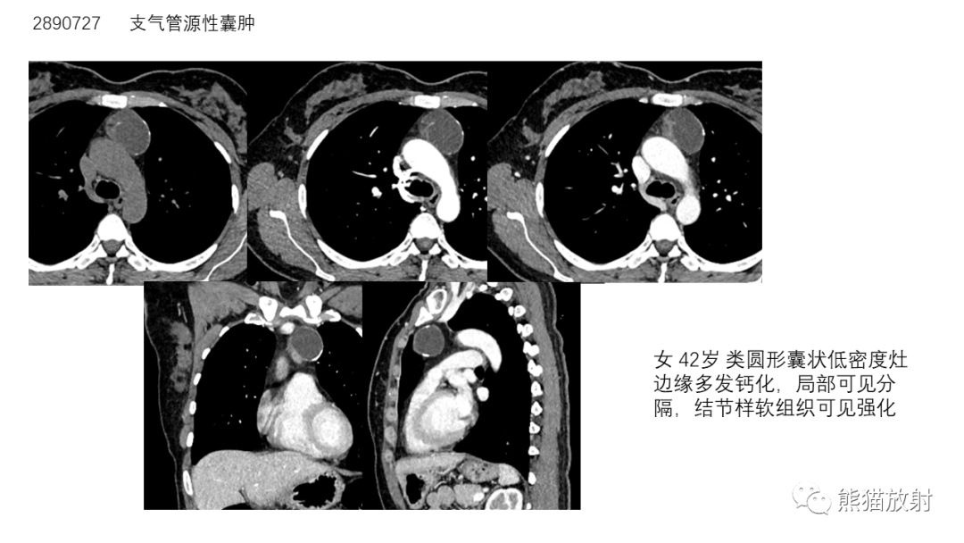 影像PPT - 【病例】前纵隔畸胎瘤2例CT影像-32