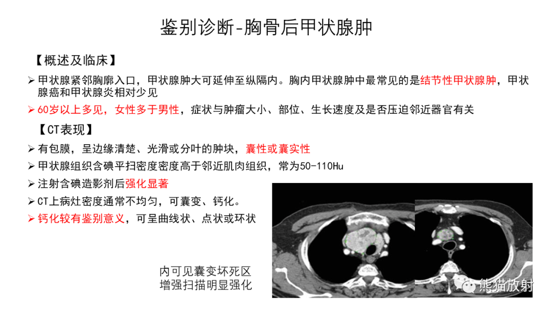 影像PPT - 【病例】前纵隔畸胎瘤2例CT影像-34