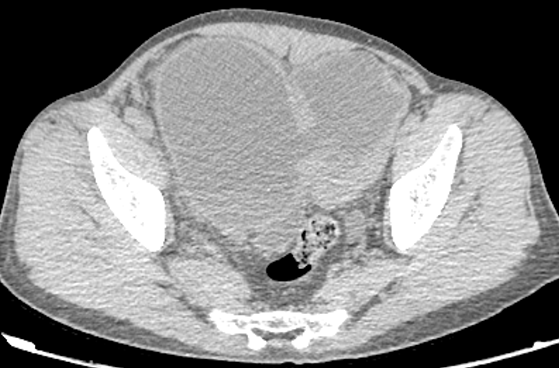 影像PPT - 【病例】腺性膀胱炎2例CT影像表现-5 影像PPT - 【病例】腺性膀胱炎2例CT影像表现-5
