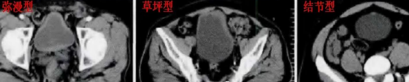 影像PPT - 【病例】腺性膀胱炎2例CT影像表现-3 影像PPT - 【病例】腺性膀胱炎2例CT影像表现-3
