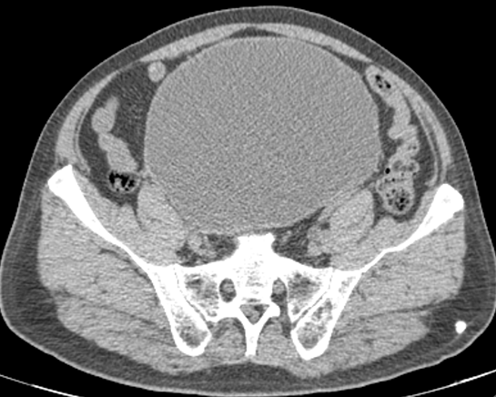 影像PPT - 【病例】腺性膀胱炎2例CT影像表现-6 影像PPT - 【病例】腺性膀胱炎2例CT影像表现-6