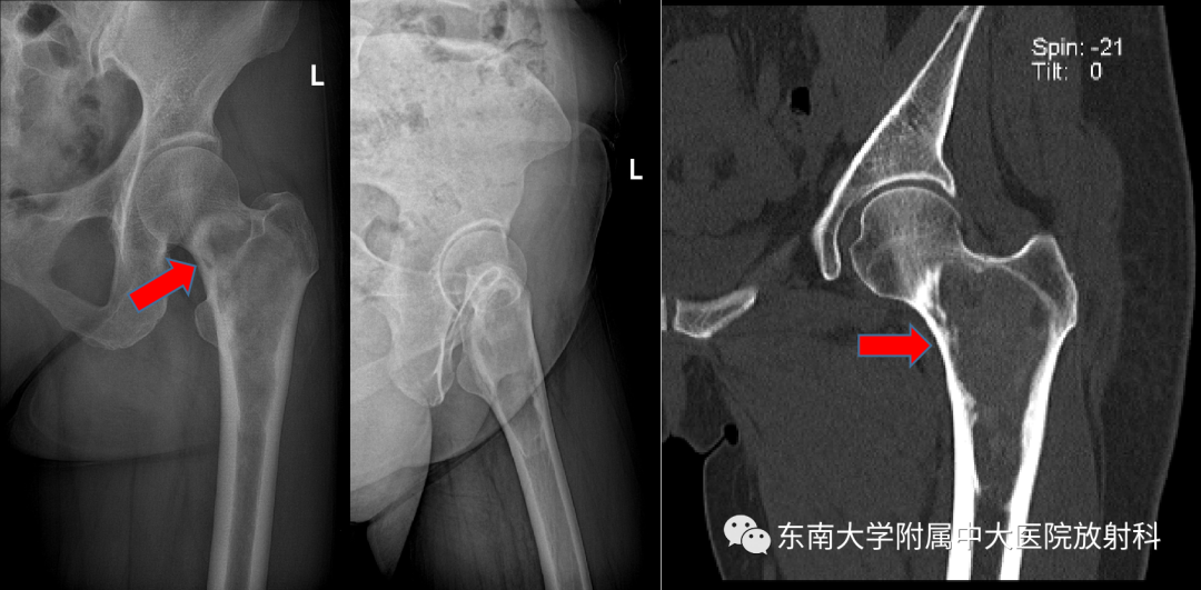 影像PPT - 【PPT】骨纤维异常增殖症-1