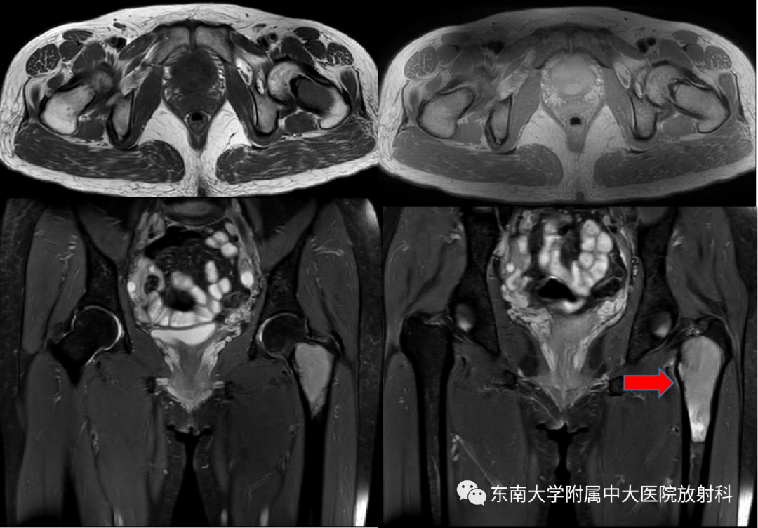 影像PPT - 【PPT】骨纤维异常增殖症-2