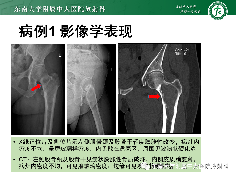 影像PPT - 【PPT】骨纤维异常增殖症-3