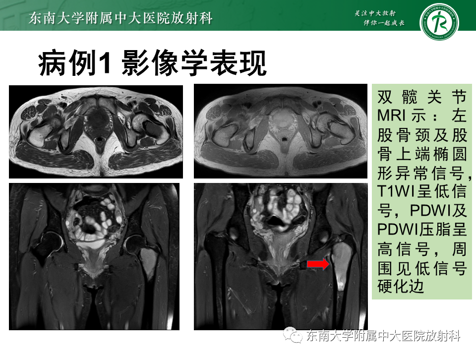 影像PPT - 【PPT】骨纤维异常增殖症-4