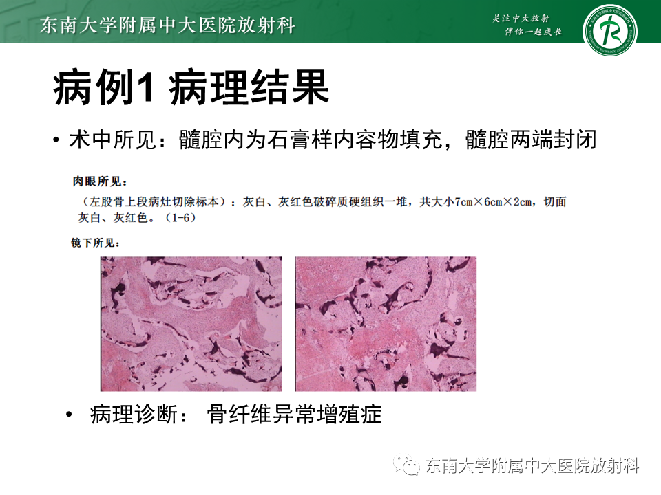 影像PPT - 【PPT】骨纤维异常增殖症-5