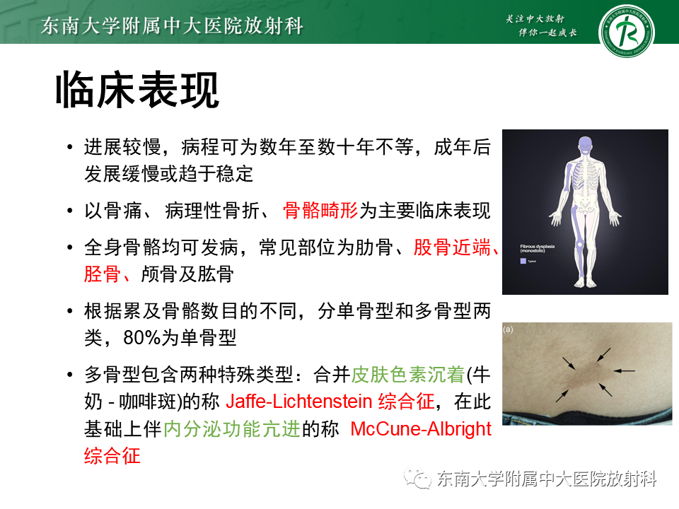影像PPT - 【PPT】骨纤维异常增殖症-9