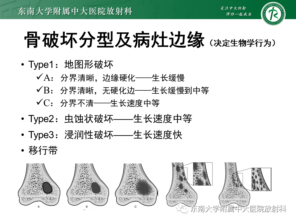 影像PPT - 【PPT】骨纤维异常增殖症-10