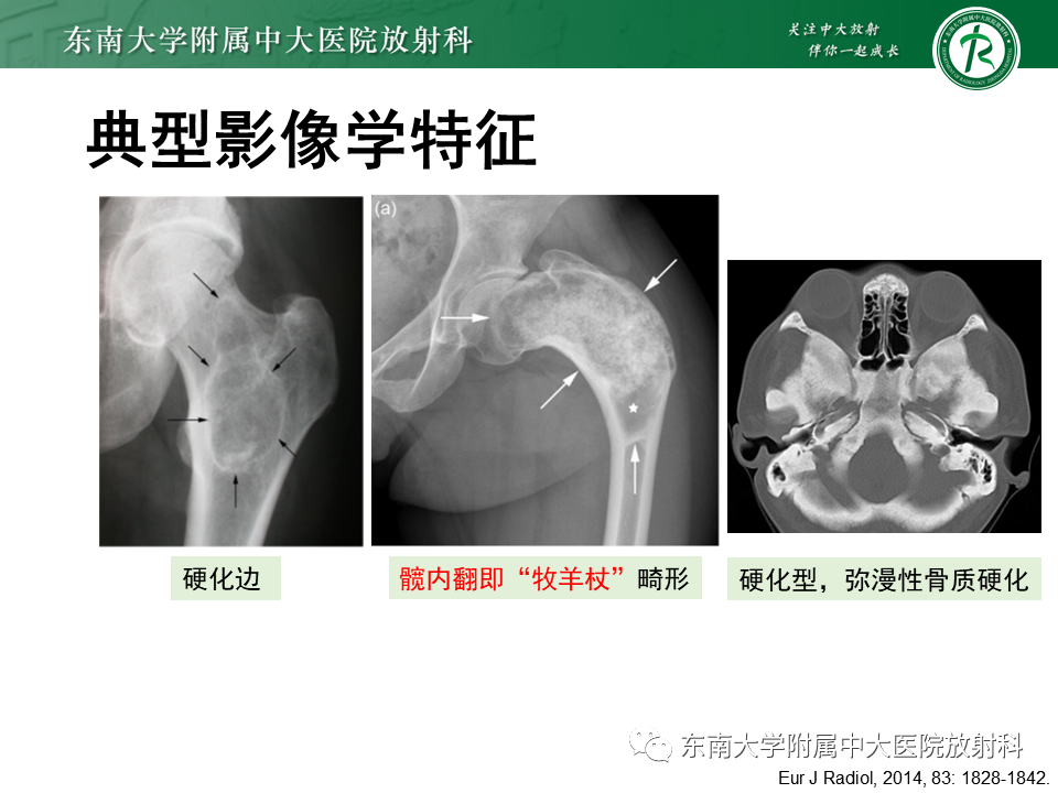 影像PPT - 【PPT】骨纤维异常增殖症-13