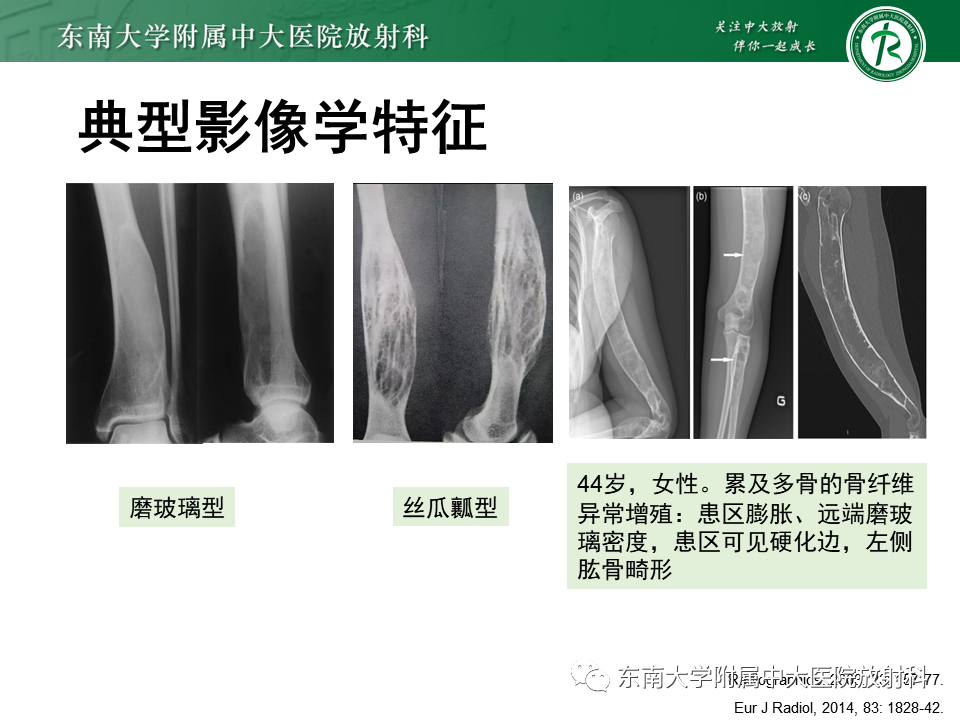 影像PPT - 【PPT】骨纤维异常增殖症-14
