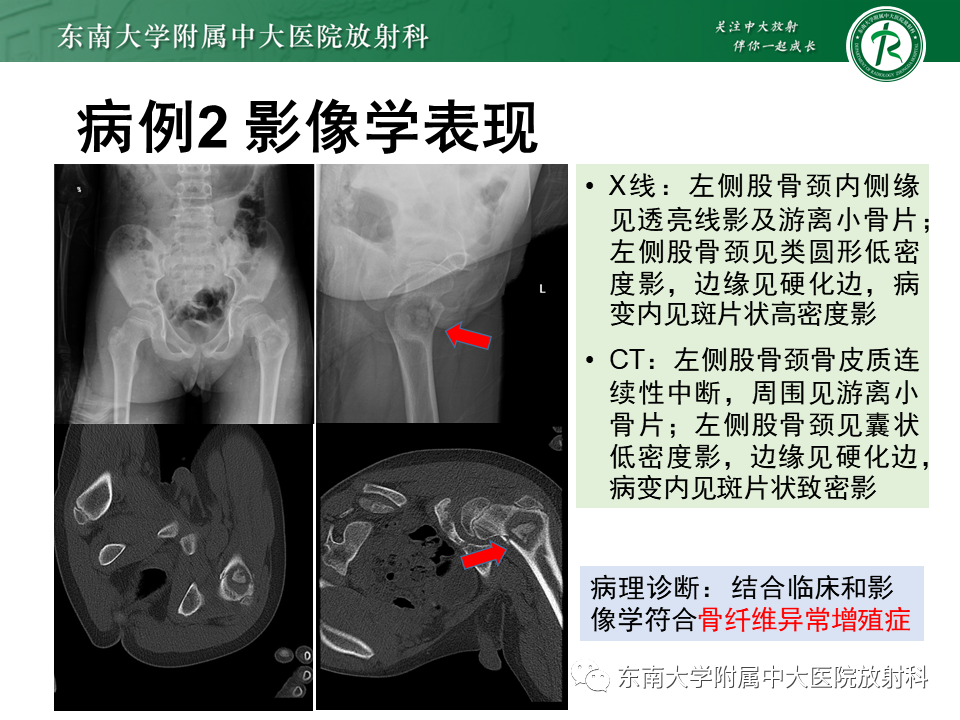 影像PPT - 【PPT】骨纤维异常增殖症-16