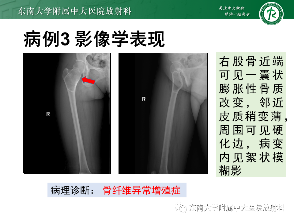 影像PPT - 【PPT】骨纤维异常增殖症-18