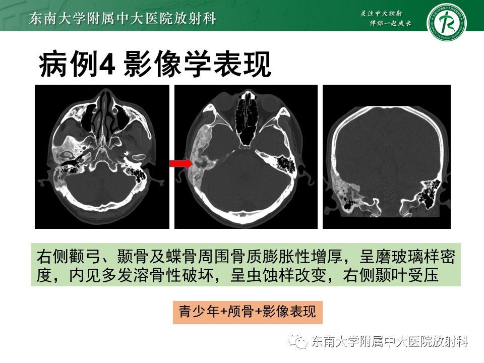 影像PPT - 【PPT】骨纤维异常增殖症-20
