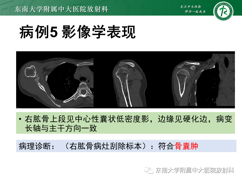 影像PPT - 【PPT】骨纤维异常增殖症-24